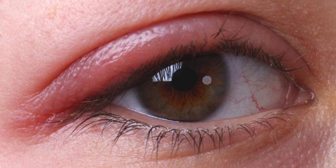 Mengapa gatal mata: blepharitis
