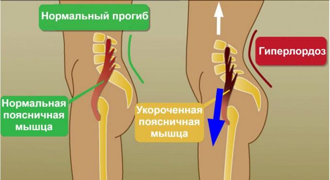 maju perpecahan: psoas