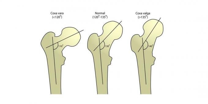 leher femoralis: Angle