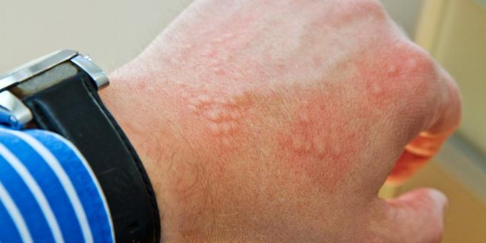 Ruam tubuh: dermatitis kontak