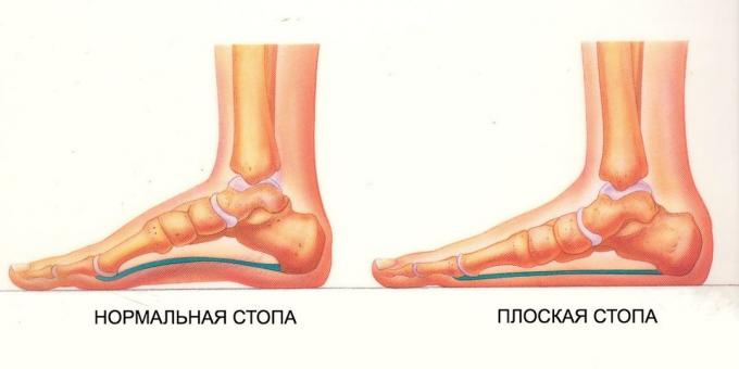 latihan untuk kaki datar: kaki normal dan datar