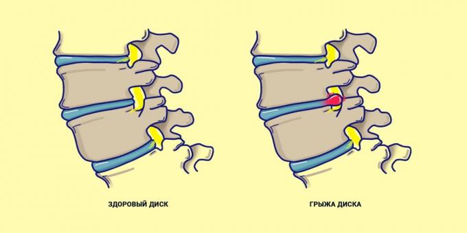 Hernia tulang belakang dibandingkan dengan kembali sehat