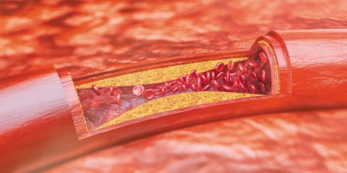 Kolesterol: plak aterosklerotik