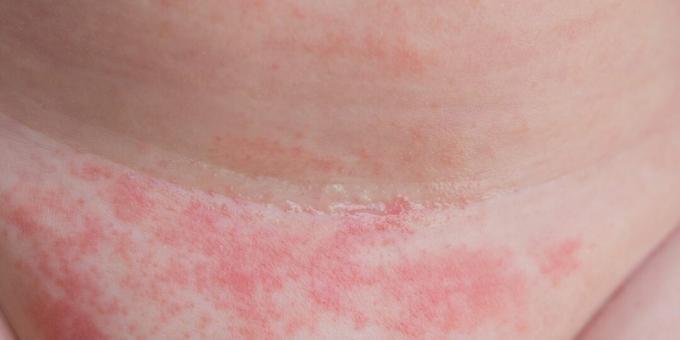 Dermatomikosis: kandidiasis kulit