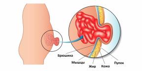 Dari mana asal hernia pusar dan cara mengobatinya