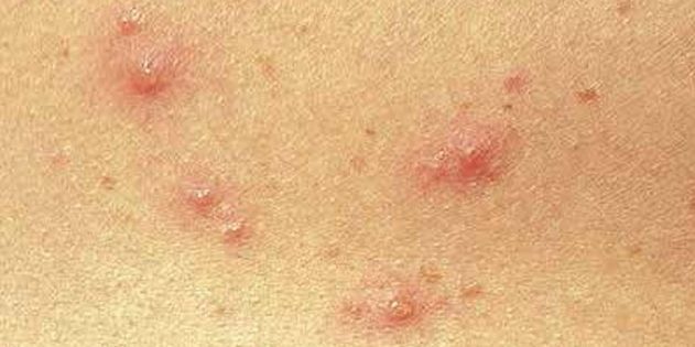 Gejala cacar pada anak-anak dan orang dewasa: Cukup sering, kulit langsung tampil titik-titik merah kecil