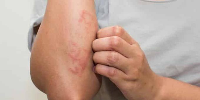 Verifikasi gejala dengan gejala alergi