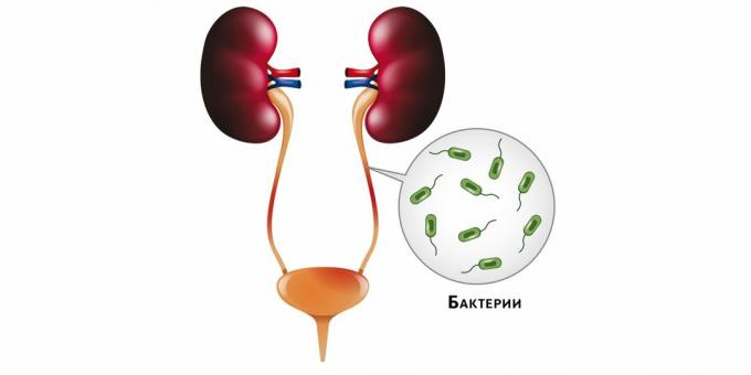 Dengan pielonefritis, bakteri masuk ke ginjal